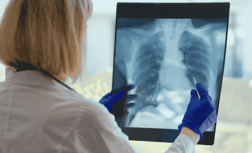 איכות האוויר וסרטן ריאות