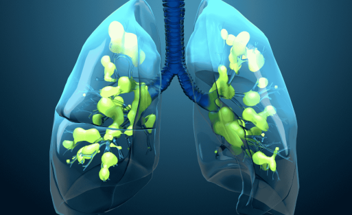 האם עלייה באשפוזים של זיהום בדרכי הנשימה